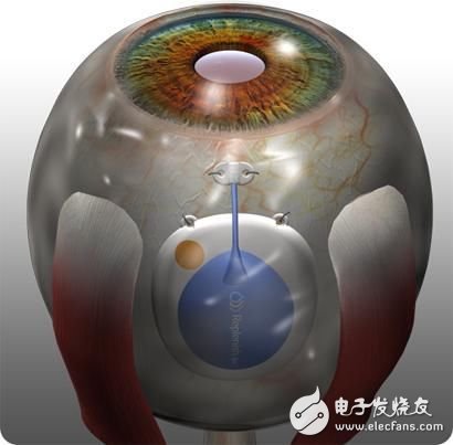 Replenish公司的可植入微流体泵可以安置在眼内，可以在需要时精确地释出几纳升的药物，可以持续工作九个月才需要重新装药