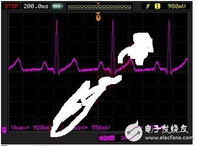 基于微功耗IC实现延长监护仪电池寿命的方案解析